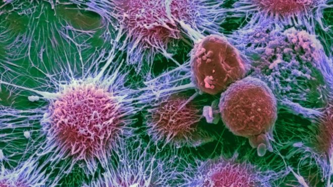 150926141319_cancer_624x351_sciencephotolibrary_nocredit