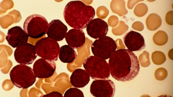 160216135018_cancer_624x351_sciencephotolibrary_nocredit