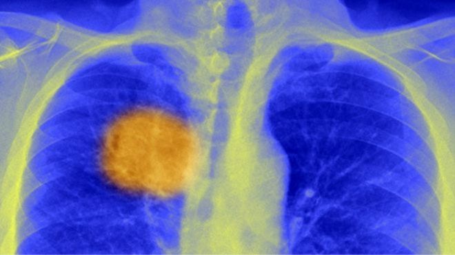 160304082251_lung_cancer_xray_640x360_spl_nocredit